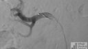 Renal Sympathetic Denervation using the Ardian Symplicity Catheter